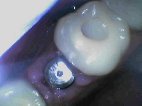 #4 implant with healing abutment